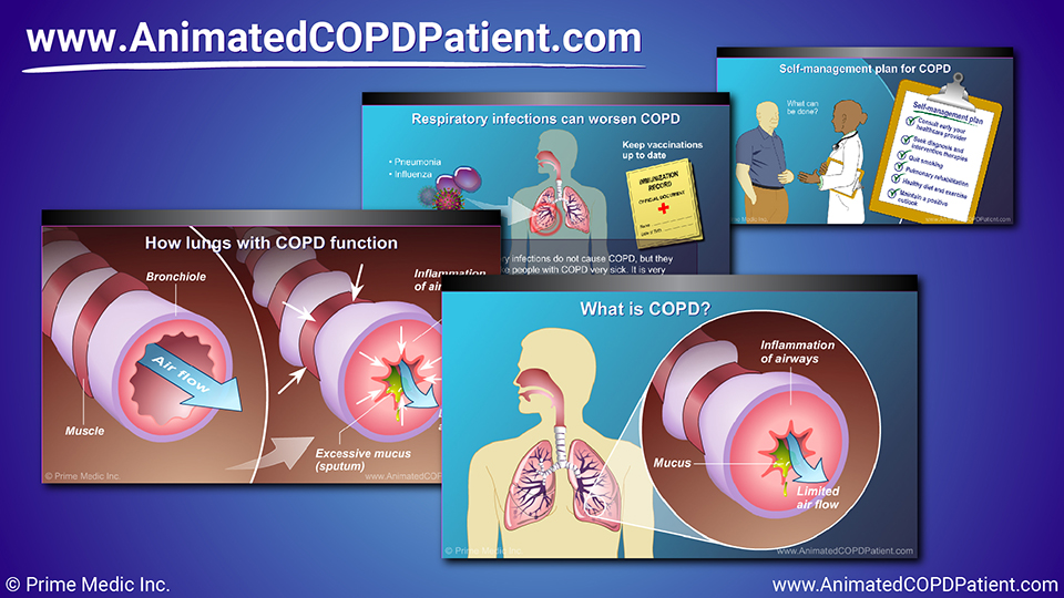Slide Show - Understanding COPD